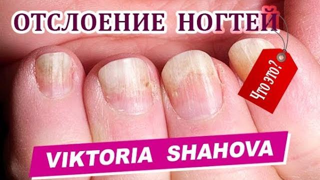 Онихолизис (отслоение ногтей): причины, диагностика Онихолизис (отслоение ногтей): причины, диагностика