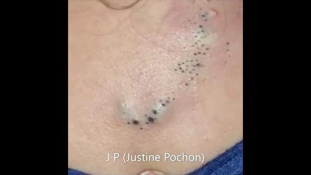 Blackheads // pimple Blackheads // pimple