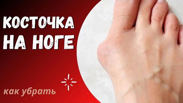 Косточка на ноге - как от нее избавиться Косточка на ноге - как от нее избавиться