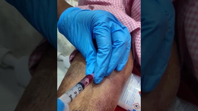 Easy way abg blood sampling | #test #blood #easyway #viral #view #vital #collection #shorts #abg Easy way abg blood sampling | #test #blood #easyway #viral #view #vital #collection #shorts #abg