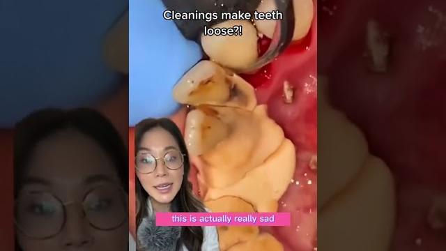 Loose teeth after cleaning. #tartarremoval #plaqueremoval #cleaning #teethcleaning #dentist Loose teeth after cleaning. #tartarremoval #plaqueremoval #cleaning #teethcleaning #dentist