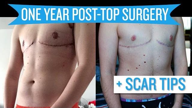 One year post top surgery + scar tips One year post top surgery + scar tips