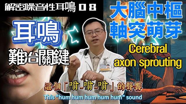耳神雙專dr 陳建志|解密噪音性耳鳴 (08) 噪音侵襲,大腦軸突萌芽,長出新的分支,耳鳴惡性循環,變暴走音響 #耳鳴 #腦鳴 #聽覺 #軸突萌芽 #自律神經 #噪音 #科普 #耳鳴測定術 耳神雙專dr 陳建志|解密噪音性耳鳴 (08) 噪音侵襲,大腦軸突萌芽,長出新的分支,耳鳴惡性循環,變暴走音響 #耳鳴 #腦鳴 #聽覺 #軸突萌芽 #自律神經 #噪音 #科普 #耳鳴測定術