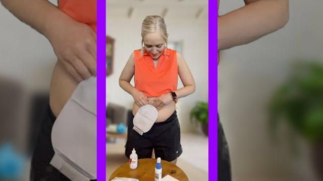 Ostomy bag change! #shorts #ostomy #ibd Ostomy bag change! #shorts #ostomy #ibd