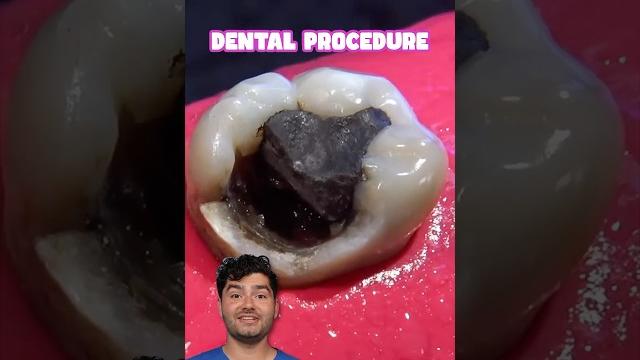 Dental filling explained !? Dental filling explained !?