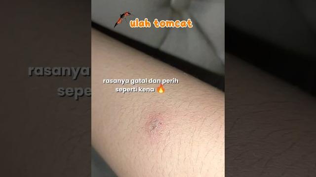 Selain ruam popok gigitan serangga tomcat juga bisa meredakan gatal, perih dan bisa sembuh no bekas Selain ruam popok gigitan serangga tomcat juga bisa meredakan gatal, perih dan bisa sembuh no bekas