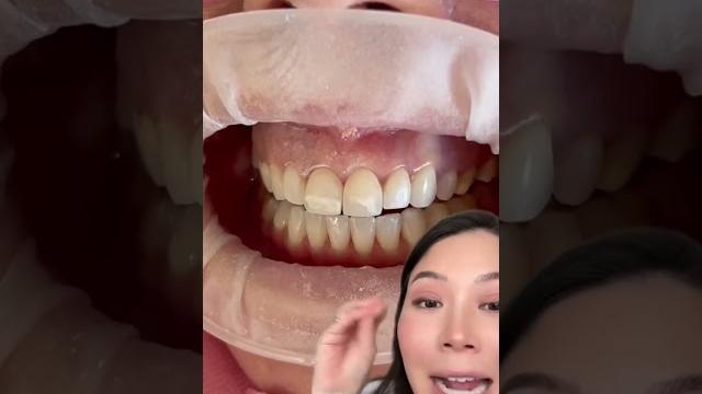 Can you remove composite veneers? #veneer #veneers #compositeveneers #porcelainveneers #composite Can you remove composite veneers? #veneer #veneers #compositeveneers #porcelainveneers #composite