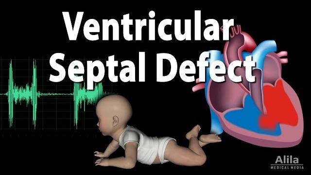 Ventricular septal defect, animation Ventricular septal defect, animation