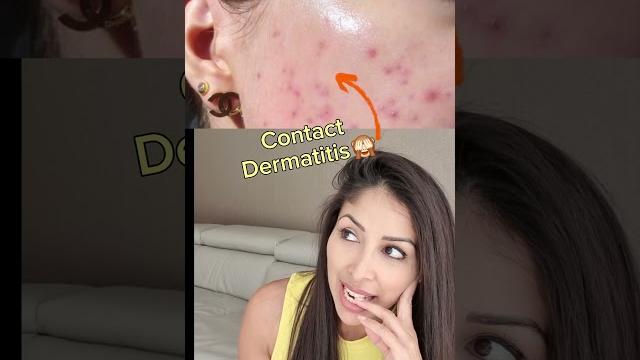 Viral teen skincare is burning faces. dr v xxx Viral teen skincare is burning faces. dr v xxx