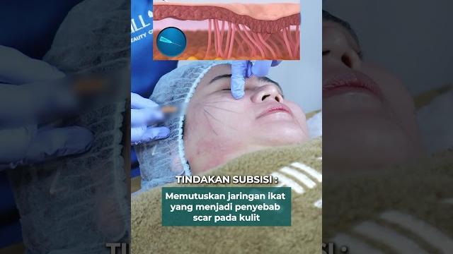 Bopeng jadi berkurang tekstur kulit makin halus? dapatkan hasil yang nyata hanya di klinik hill skin Bopeng jadi berkurang tekstur kulit makin halus? dapatkan hasil yang nyata hanya di klinik hill skin