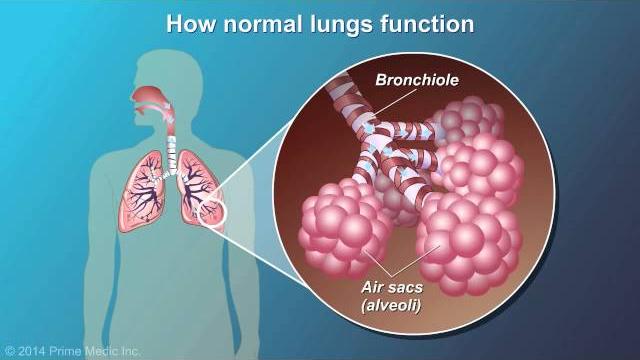 Understanding copd Understanding copd