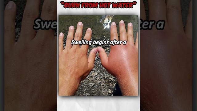 How to survive when get "burn from hot water" How to survive when get "burn from hot water"