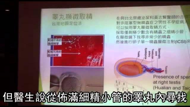 顯微鏡取精 無精男當爸 --蘋果日報20150806 顯微鏡取精 無精男當爸 --蘋果日報20150806