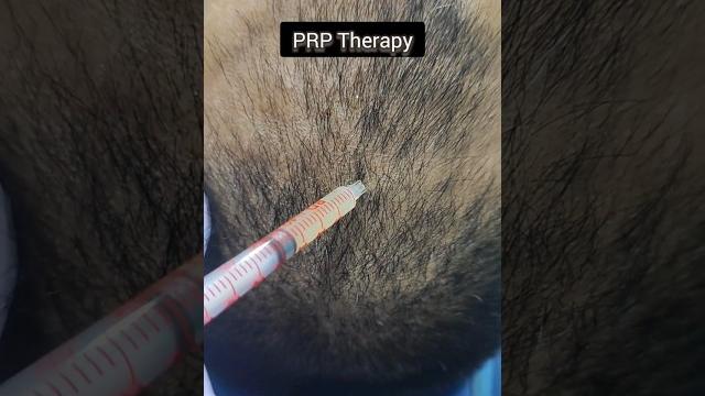Prp v/s gfc therapy for pattern hair loss amazing results #prptherapy #gfctherapy #hairlosstreatment Prp v/s gfc therapy for pattern hair loss amazing results #prptherapy #gfctherapy #hairlosstreatment