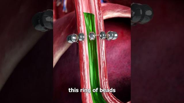 How beads stop acid reflux How beads stop acid reflux