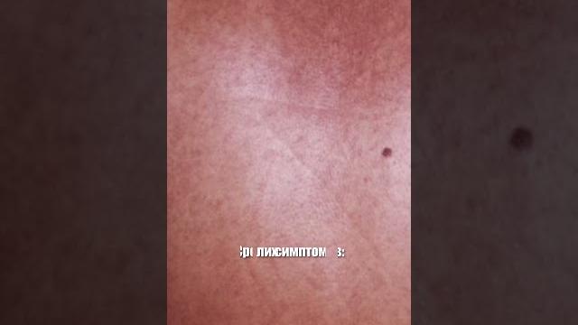 Новая эпидемия на земле из-за лихорадки марбург Новая эпидемия на земле из-за лихорадки марбург