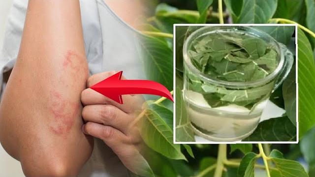 Тери касалликлари кийнаяптими ??? Тери касалликлари кийнаяптими ???