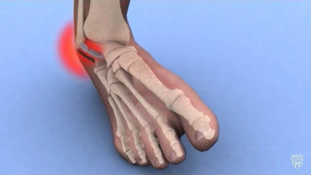 Mayo clinic minute: ankle sprains 101 Mayo clinic minute: ankle sprains 101