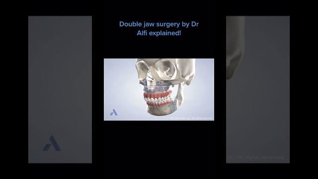 Classified info, dr alfi describes custom double jaw surgery! the secret is out don't share this Classified info, dr alfi describes custom double jaw surgery! the secret is out don't share this