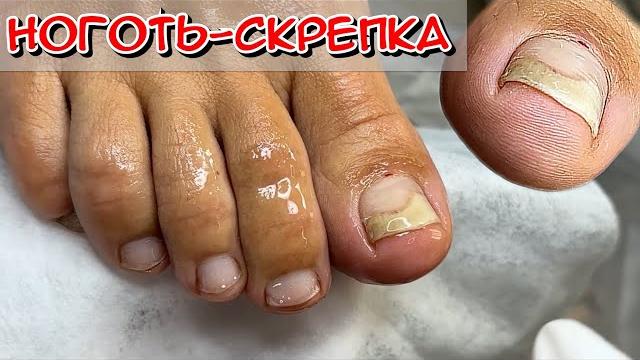 Ноготь-скрепка /почему ноготь скручивается? / онихолизис ногтей / причины онихолизиса /что с ногтем? Ноготь-скрепка /почему ноготь скручивается? / онихолизис ногтей / причины онихолизиса /что с ногтем?