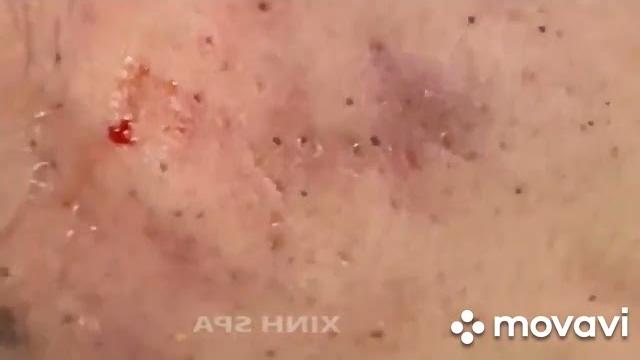 Очень красиво выдавливание черных точек самое залипательное видео выдавливание прыщей, Очень красиво выдавливание черных точек самое залипательное видео выдавливание прыщей,