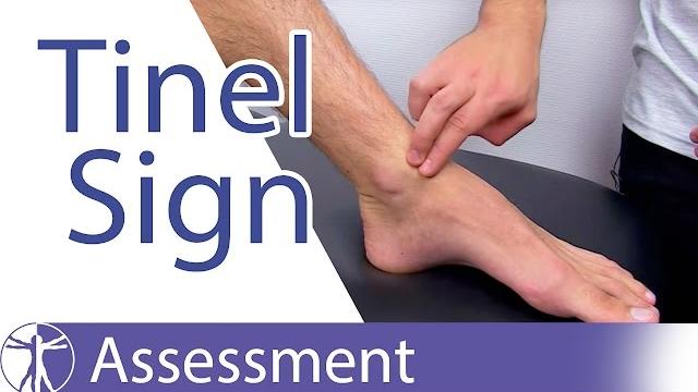 Tinel's sign (ankle)⎟peripheral nerve injury Tinel's sign (ankle)⎟peripheral nerve injury