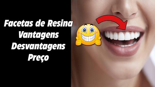 Facetas de resina - preço, vantagens, antes e depois #shorts Facetas de resina - preço, vantagens, antes e depois #shorts