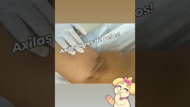 Depilação definitiva, clínica plena, xique xique, ba Depilação definitiva, clínica plena, xique xique, ba