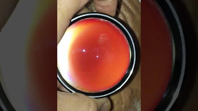 Digital fundoscopy #fundus #eye #retina Digital fundoscopy #fundus #eye #retina