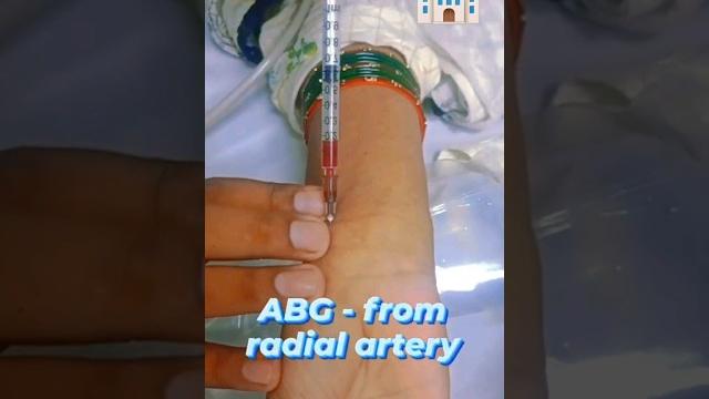 How to take a radial arterial blood gas (abg) sample" / #medical #information #about #abg #simple How to take a radial arterial blood gas (abg) sample" / #medical #information #about #abg #simple