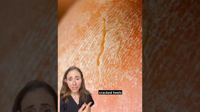 Get rid of dry, cracked feet #dermatologist Get rid of dry, cracked feet #dermatologist