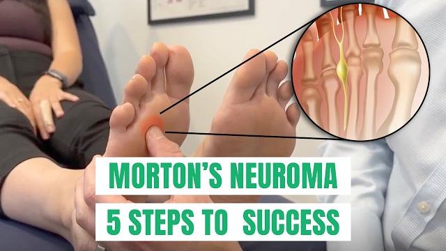 Morton’s neuroma: 5 tips to solve forefoot pain Morton’s neuroma: 5 tips to solve forefoot pain