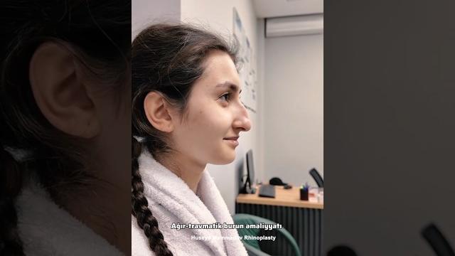 #reels #rhinoplastysociety #rhino #beauty #nosesurgery #burunestetigi #estetikburun #skincare #reels #rhinoplastysociety #rhino #beauty #nosesurgery #burunestetigi #estetikburun #skincare