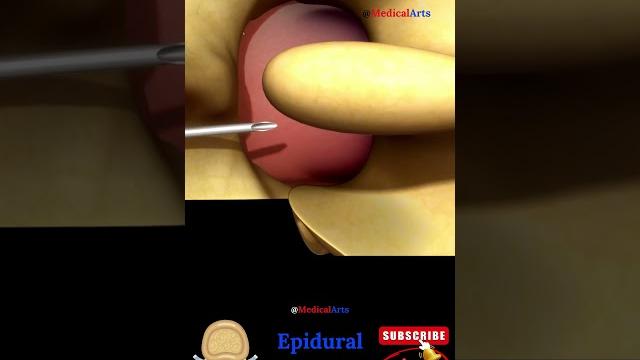 Epidural injection - epidural anesthesia Epidural injection - epidural anesthesia