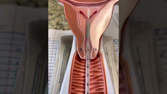 Moving of male sperms in female vagina Moving of male sperms in female vagina