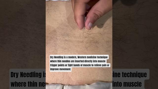 #physicaltherapy#doctor#chiropractor#dryneedling#taping#iastm#painrelief#mobility#rehabilitation #physicaltherapy#doctor#chiropractor#dryneedling#taping#iastm#painrelief#mobility#rehabilitation