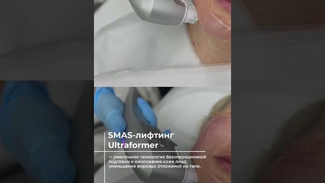 Подтяжка лица без операций! #лифтинг #лифтингвек #коррекцияовала #королёв #второйподбородок #мытищи Подтяжка лица без операций! #лифтинг #лифтингвек #коррекцияовала #королёв #второйподбородок #мытищи