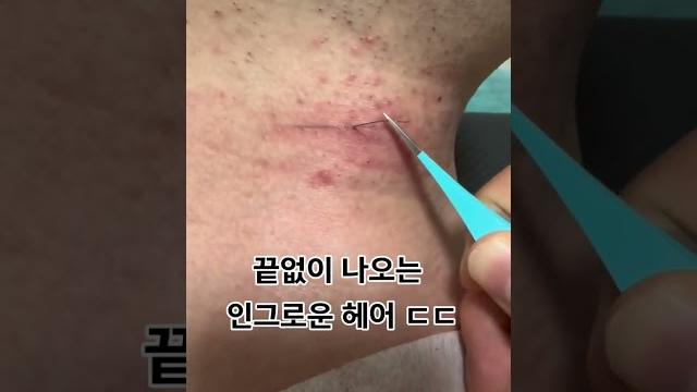 끝 없이 나오는 인그로운 헤어 ㄷㄷ.. 끝 없이 나오는 인그로운 헤어 ㄷㄷ..