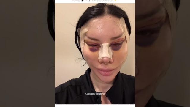 Full face surgery#shorts #cosmeticsurgery #beauty Full face surgery#shorts #cosmeticsurgery #beauty