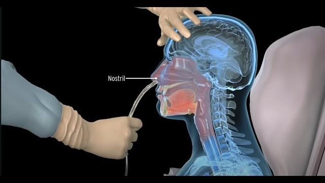 Нг-интубация - установка назогастрального зонда - 3d анимация Нг-интубация - установка назогастрального зонда - 3d анимация