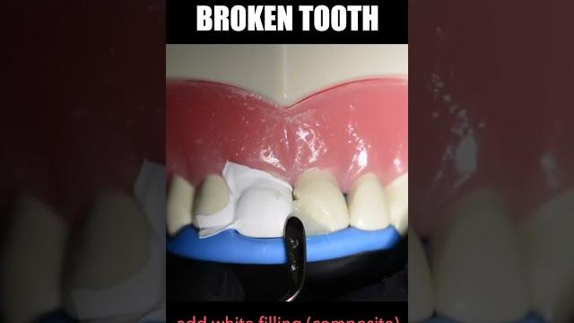 Tooth filling #shorts Tooth filling #shorts