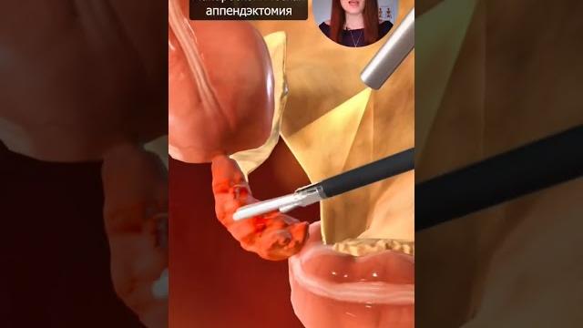Как удаляют аппендицит? Как удаляют аппендицит?