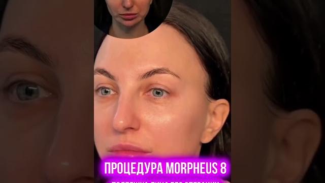 Подтяжка лица без операции? Подтяжка лица без операции?