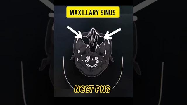 Normal maxillary sinus view/ncct pns/radiology #viral #shorts #radiology #doctor #medical Normal maxillary sinus view/ncct pns/radiology #viral #shorts #radiology #doctor #medical