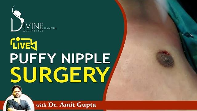 Live puffy nipple surgery Live puffy nipple surgery