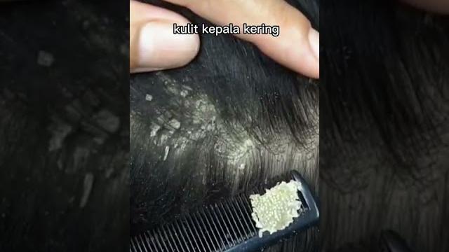 Penyebab ketombe pada rambut! Penyebab ketombe pada rambut!