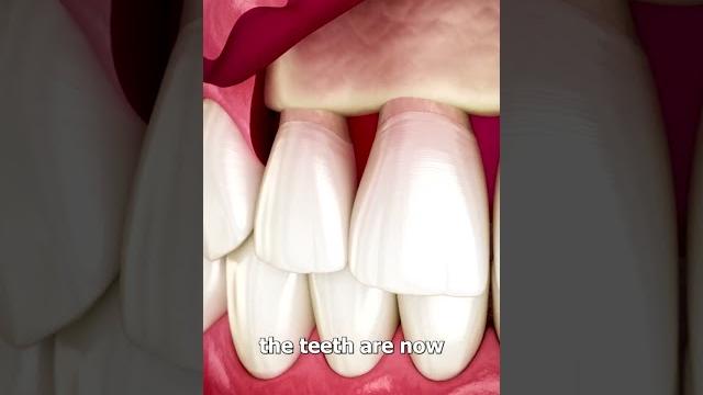 The surgery to reveal more teeth The surgery to reveal more teeth
