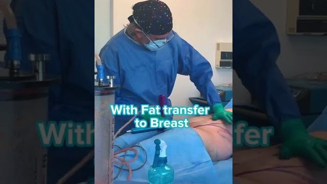 Lipo 360º + fat transfer to breast by dr.bucio #plasticsurgery #lipo360 #tijuana #sandiego #lipo Lipo 360º + fat transfer to breast by dr.bucio #plasticsurgery #lipo360 #tijuana #sandiego #lipo