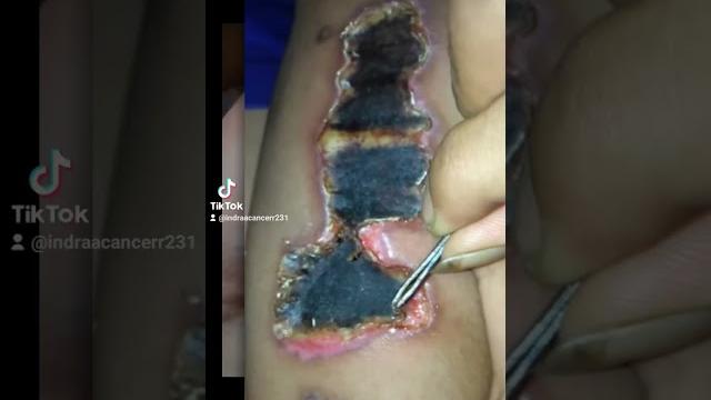 Hasil akhir hapus tato dengan kapur sirih dan sabun colek Hasil akhir hapus tato dengan kapur sirih dan sabun colek