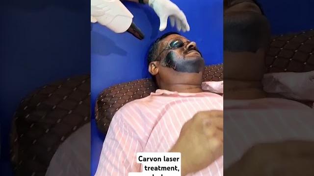 Carvon laser treatment#beauty #laserhairremoval #minivlog #hydrafacial #permanenttattoo #skincare Carvon laser treatment#beauty #laserhairremoval #minivlog #hydrafacial #permanenttattoo #skincare
